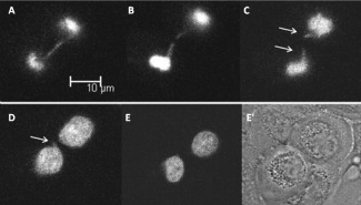 Disfunció Telomèrica