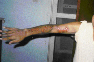 Persona afectada de esporotricosi en els ganglis