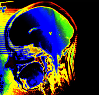 Codi Ictus. Foto Flickr