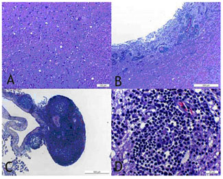 Lesions espongiformes i inflamatòries concomitants.