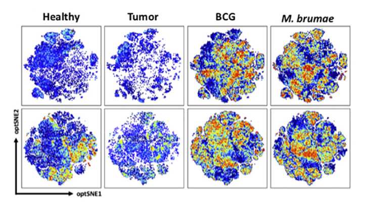 Perfil global de les cèl·lules immunitàries infiltrades a la bufeta